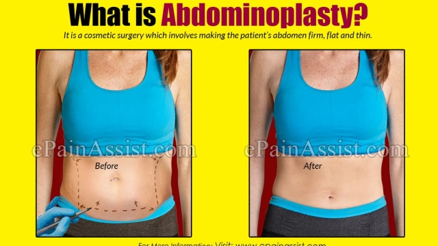 Flatten Your Belly, Enhance Your Confidence: The Ultimate Guide to Abdominoplasty