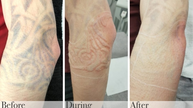 Tattoo Removers And Considerations