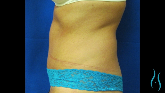 Trimming the Waistline: Unveiling the Secrets of the Tummy Tuck