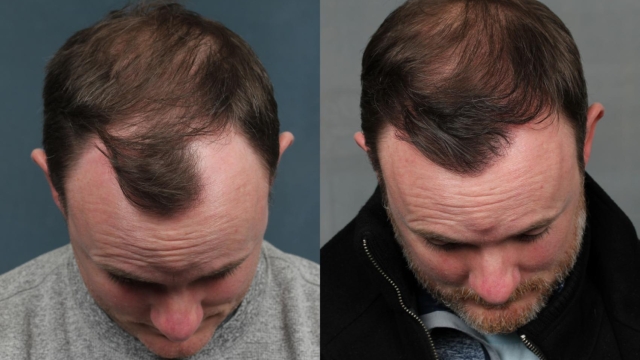 From Bald to Bold: Transforming Lives with Hair Transplants