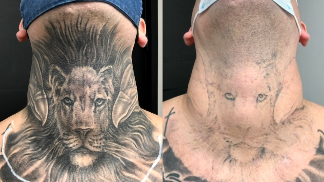 Laser Tattoo Removal – How Long Does It Take?