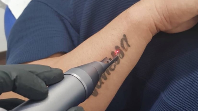 Laser Tattoo Removal Costs – Significant Cost Of Tattoo Regret