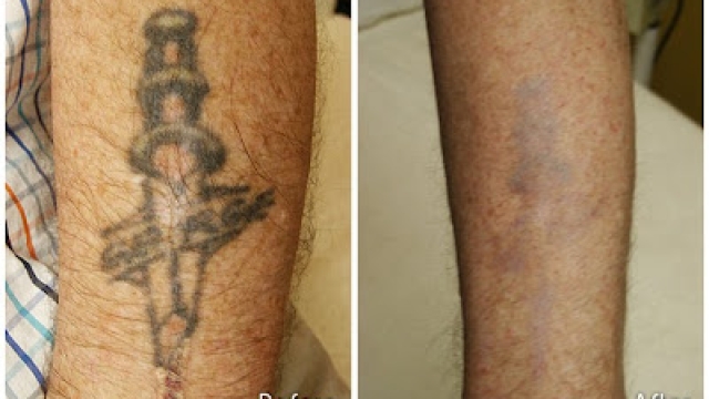 Tattoo Laser Removal – Hurts Like Heck – Is It Worth This Item?