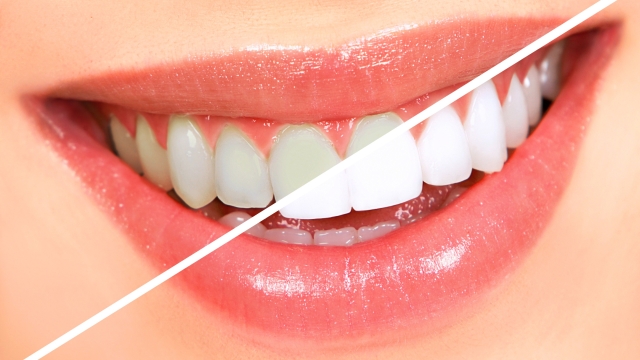 Sparkling Smiles: Unveiling the Secrets of Teeth Whitening Products