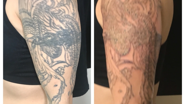 Types Of Tattoo Removal For Those Considering Tattoo Removal