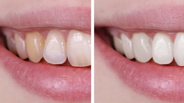 Unveiling the Secrets of Crest Whitening Strips: A Brighter Smile is Just a Strip Away!