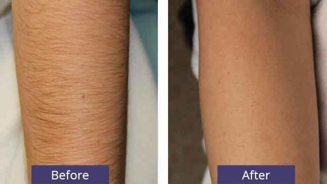 Laser Hair Removal: Unveiling the Smoothest Path to Silky Skin