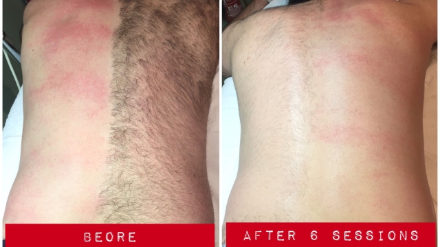 Say Goodbye to Unwanted Hair: Unleashing the Magic of Laser Hair Removal